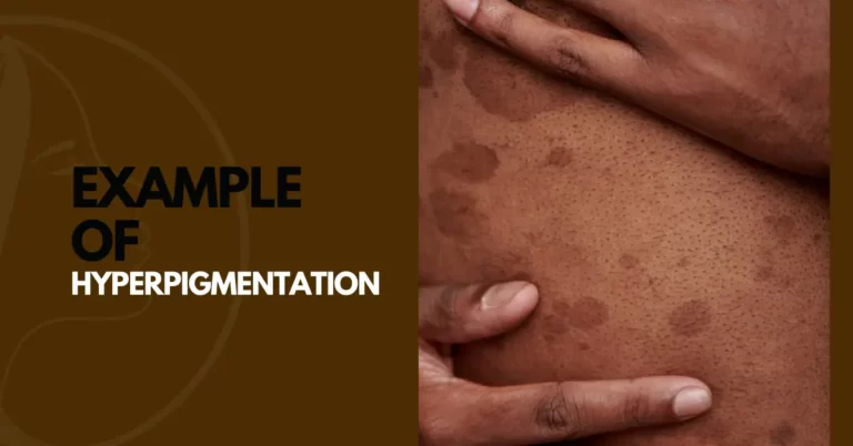 Example of Hyperpigmentation and dark complexion