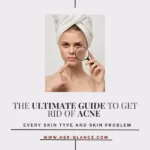 Ultimate GuIDE fOR Acne