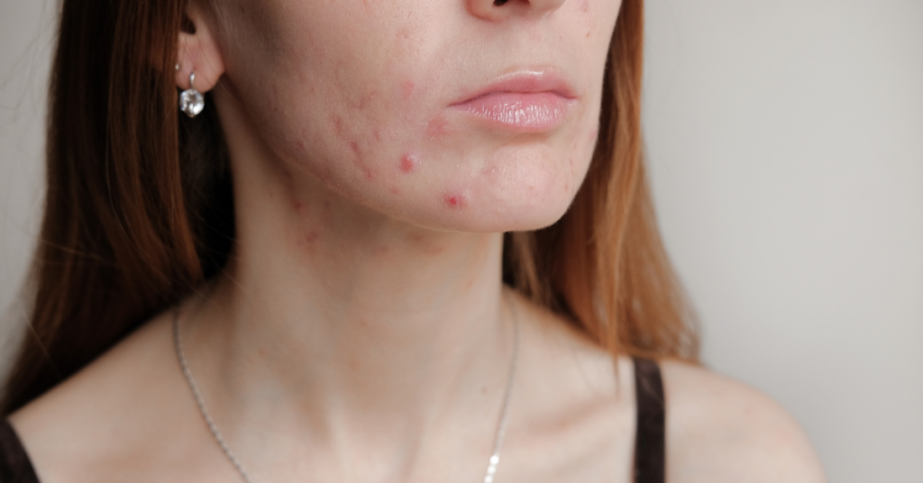 Is Neutrogena Good For Acne
